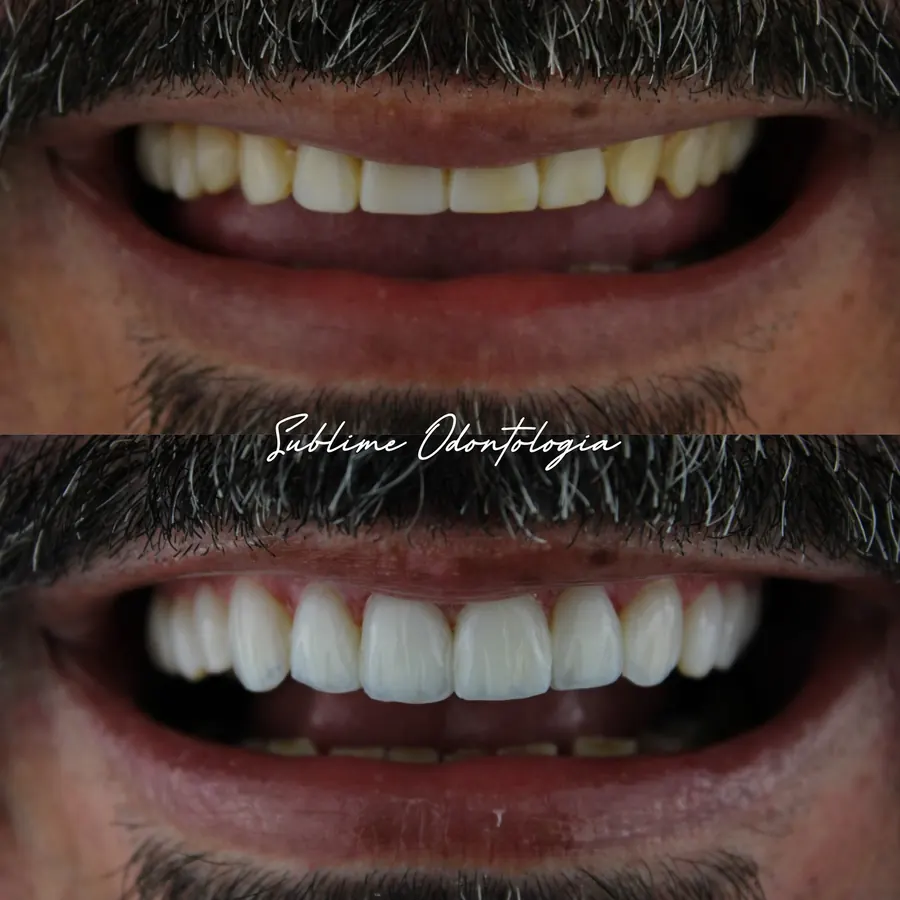 Antes e depois de lentes em resina: sorriso com dentes amarelados em cima e dentes claros e alinhados embaixo